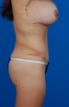 Woman's body, after Mommy Makeover treatment, r-side view, patient 1