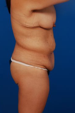 Woman's body, before Mommy Makeover treatment, r-side view, patient 1