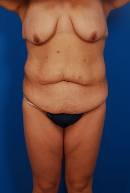 Woman's body, before Thigh Lift treatment, front view, patient 1