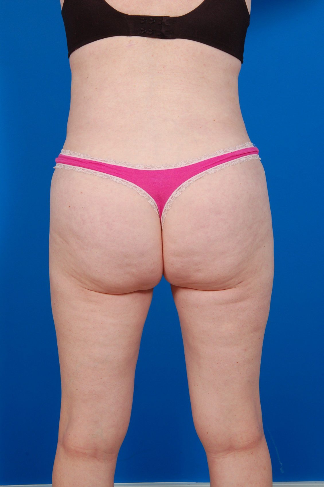 Woman's body, after Tummy Tuck treatment, back view, patient 11