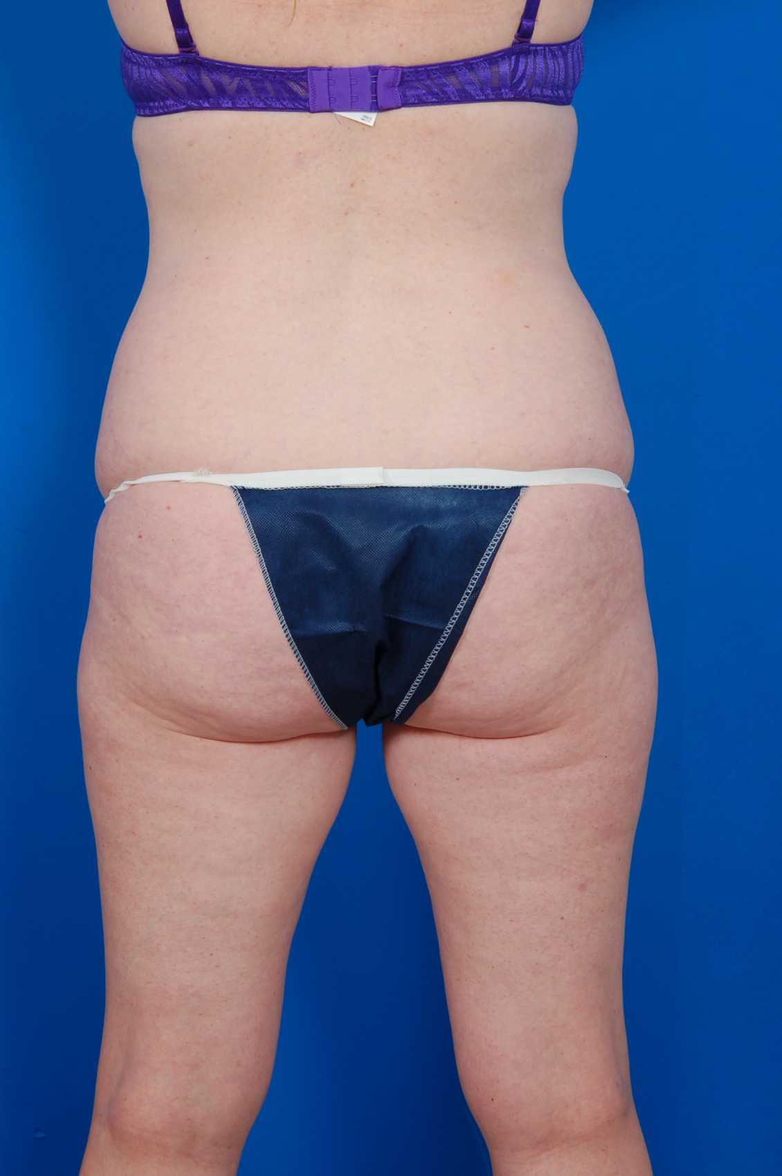 Woman's body, before Tummy Tuck treatment, back view, patient 11