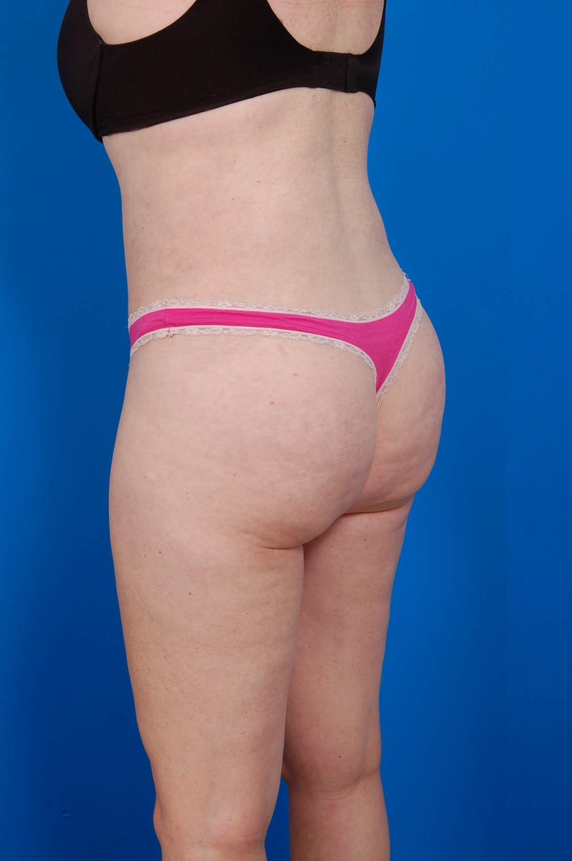 Woman's body, after Tummy Tuck treatment, l-side back view, patient 11