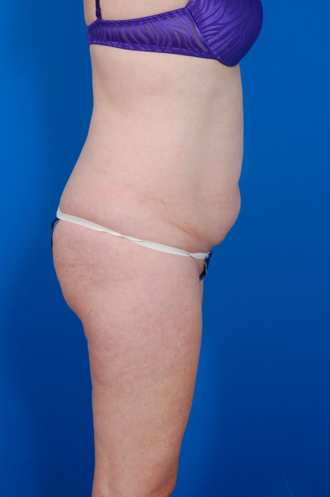 Woman's body, before Tummy Tuck treatment, r-side view, patient 11