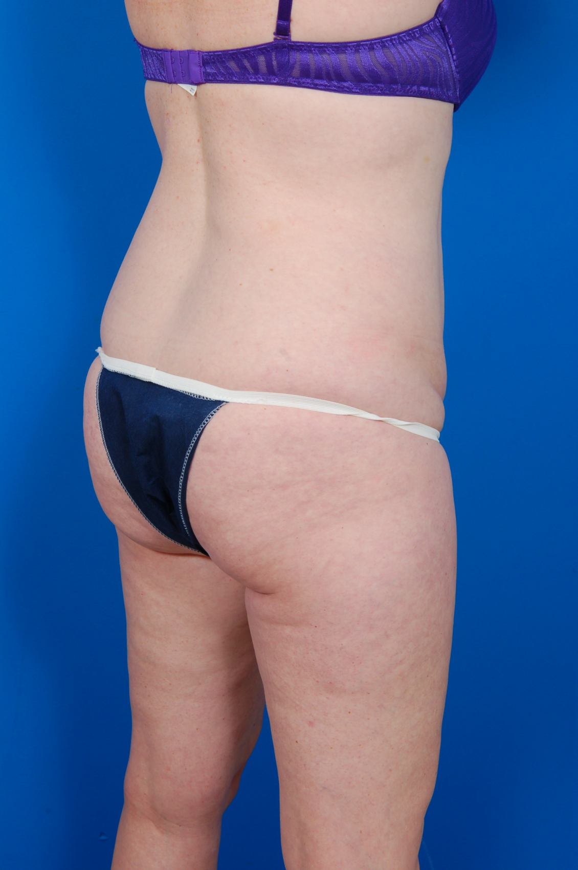 Woman's body, before Tummy Tuck treatment, r-side back view, patient 11