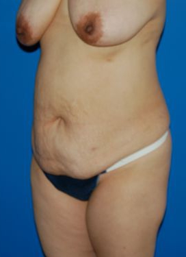 Woman's body, before Mommy Makeover treatment, l-side oblique view, patient 6