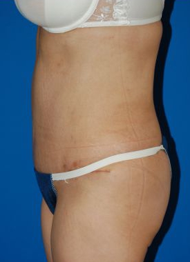 Woman's body, after Mommy Makeover treatment, l-side view, patient 6