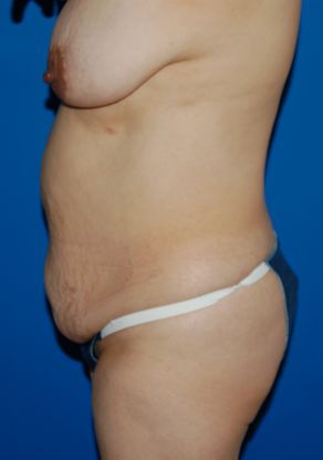 Woman's body, before Mommy Makeover treatment, l-side view, patient 6