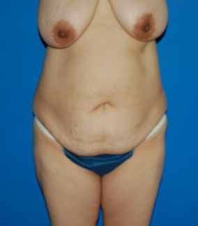 Woman's body, before Mommy Makeover treatment, front view, patient 6
