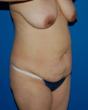 Woman's body, before Mommy Makeover treatment, r-side oblique view, patient 6