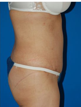 Woman's body, after Mommy Makeover treatment, r-side view, patient 6