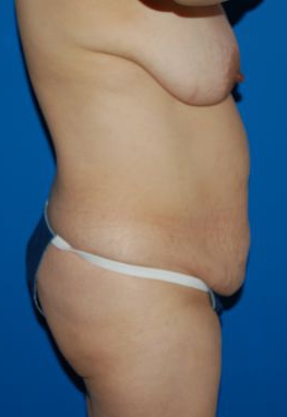 Woman's body, before Mommy Makeover treatment, r-side view, patient 6
