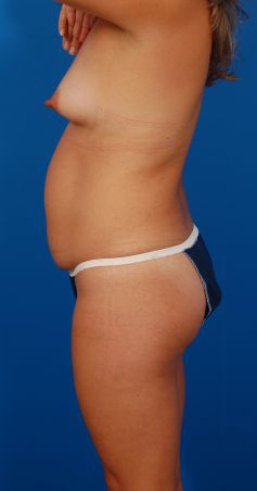 Woman's breasts, before Breast Augmentation (Implants) treatment, l-side view, patient 622