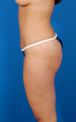 Woman's body, after Mommy Makeover treatment, l-side view, patient 7