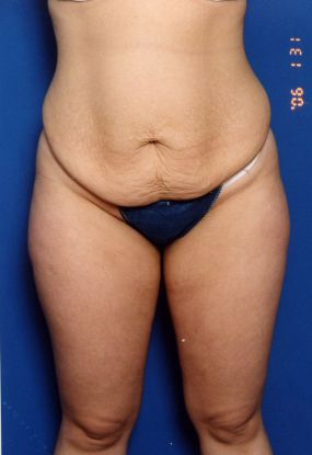 Woman's body, before Mommy Makeover treatment, front view, patient 7