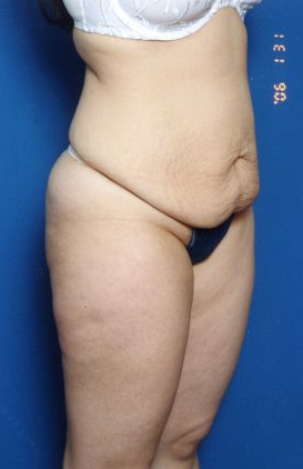 Woman's body, before Mommy Makeover treatment, r-side oblique view, patient 7