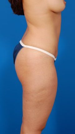 Woman's body, after Mommy Makeover treatment, r-side view, patient 7