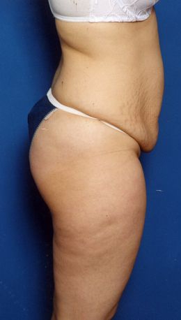 Woman's body, before Mommy Makeover treatment, r-side view, patient 7
