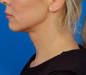 Female face, after Neck Lift using Laser Liposuction treatment, l-side view, patient 1