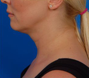 Female face, before Neck Lift using Laser Liposuction treatment, l-side view, patient 1