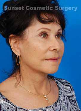 Woman's face, after Facelift treatment, r-side oblique view, patient 1