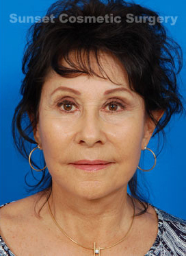 Woman's face, after Facelift treatment, front view, patient 1