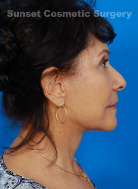 Woman's face, after Facelift treatment, r-side view, patient 1