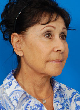 Woman's face, before Facelift treatment, r-side oblique view, patient 1