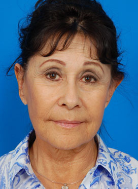 Woman's face, before Facelift treatment, front view, patient 1