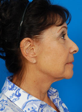 Woman's face, before Facelift treatment, r-side view, patient 1