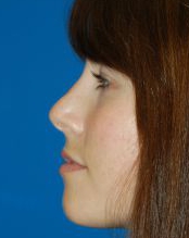 Female face, after Rhinoplasty treatment, l-side view, patient 18