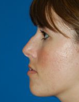 Female face, before Rhinoplasty treatment, l-side view, patient 18