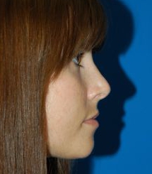 Female face, after Rhinoplasty treatment, r-side view, patient 18