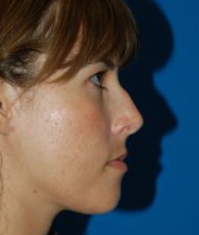 Female face, before Rhinoplasty treatment, r-side view, patient 18