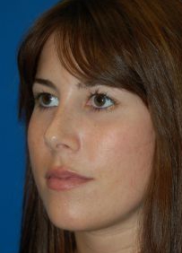 Female face, after Rhinoplasty treatment, l-side oblique view, patient 18