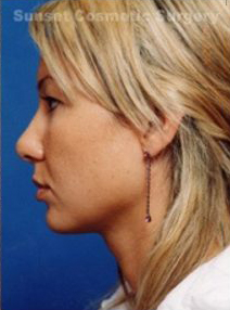 Female face, after Rhinoplasty treatment, l-side view, patient 2