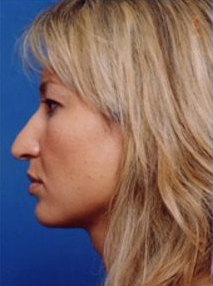 Female face, before Rhinoplasty treatment, l-side view, patient 2