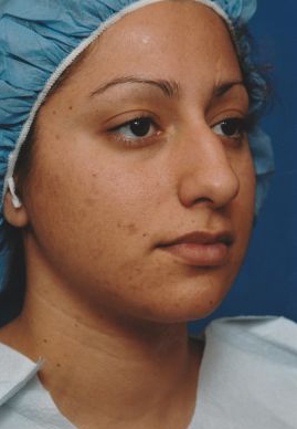 Female face, before Rhinoplasty treatment, r-side oblique view, patient 32