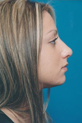 Female face, after Rhinoplasty treatment, r-side view, patient 32