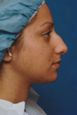 Female face, before Rhinoplasty treatment, r-side view, patient 32