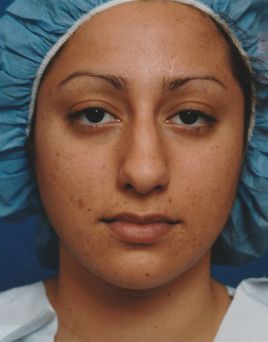 Female face, before Rhinoplasty treatment, front view, patient 32