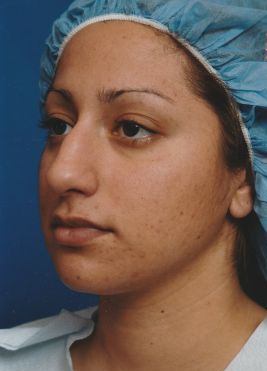 Female face, before Rhinoplasty treatment, l-side oblique view, patient 32