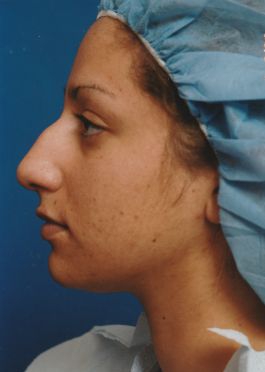 Female face, before Rhinoplasty treatment, l-side view, patient 32