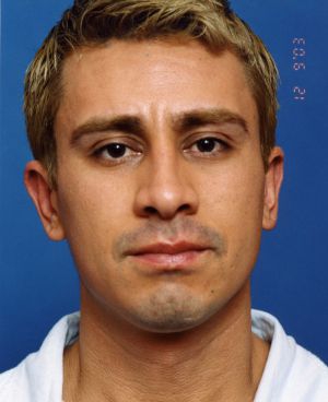 Male face, after Rhinoplasty treatment, front view, patient 4