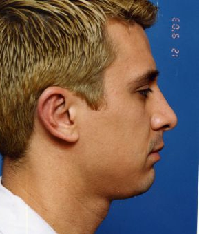 Male face, after Rhinoplasty treatment, r-side view, patient 4