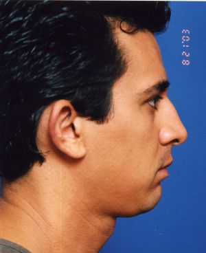 Male face, before Rhinoplasty treatment, r-side view, patient 4
