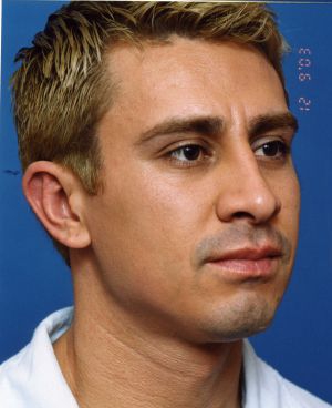 Male face, after Rhinoplasty treatment, r-side oblique view, patient 4