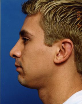 Male face, after Rhinoplasty treatment, l-side view, patient 4