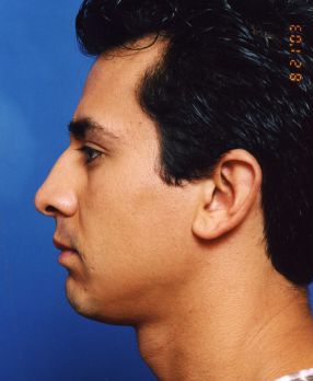 Male face, before Rhinoplasty treatment, l-side view, patient 4