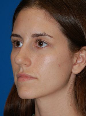 Female face, after Rhinoplasty treatment, l-side oblique view, patient 484