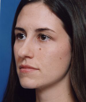 Female face, before Rhinoplasty treatment, l-side oblique view, patient 484